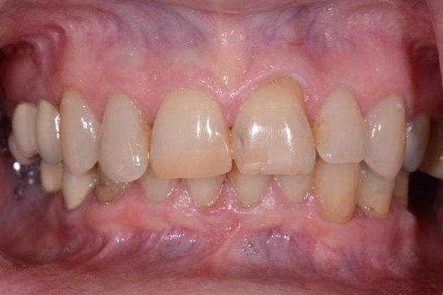 before veneers